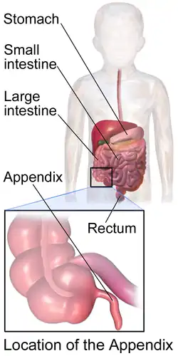 Appendix in a child.