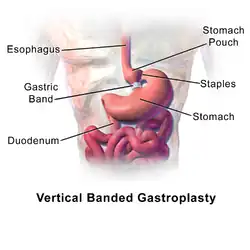 Vertical banded gastroplasty surgery.